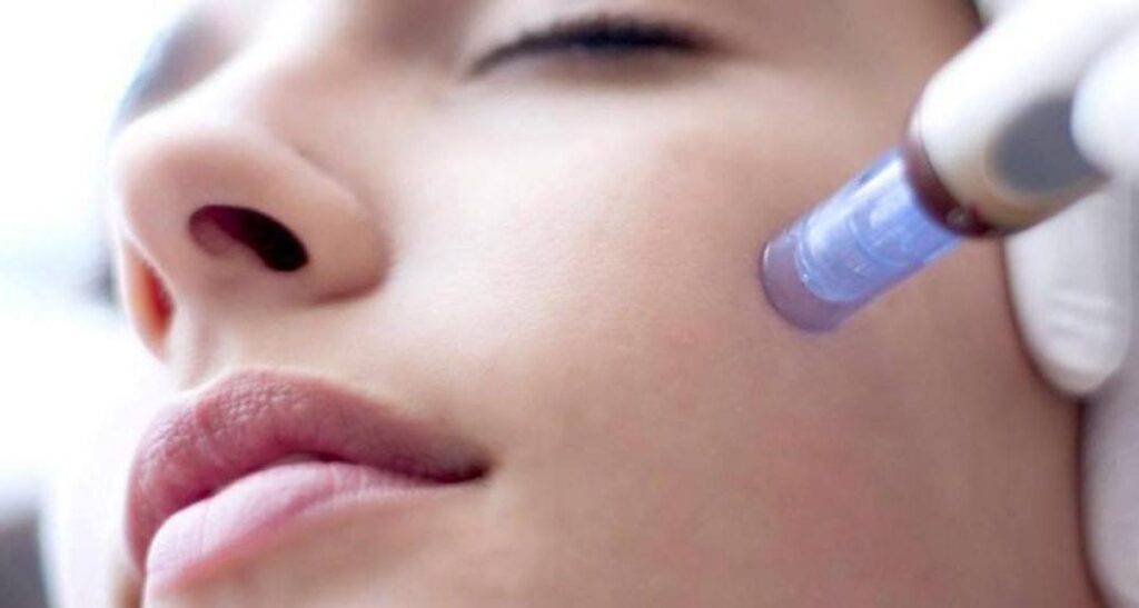 microneedling for oily skin